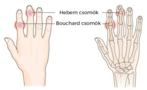 hebern csomók - bouchard csomók